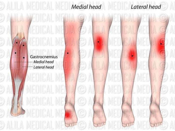 Calf trigger points