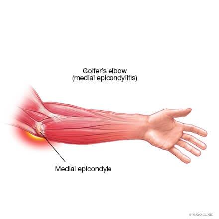 Golfer's elbow