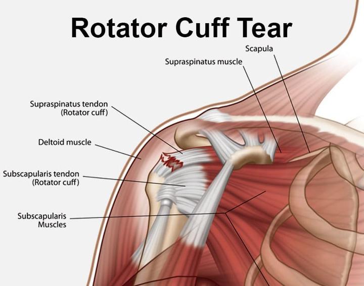 Rotator cuff tear