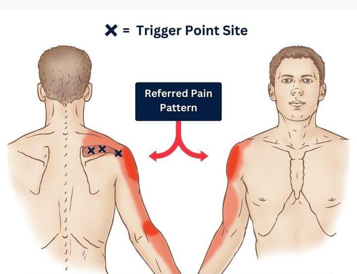 Trigger point referral